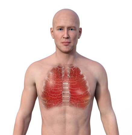 Foto de Una ilustración fotorrealista en 3D que muestra la mitad superior de un hombre con piel transparente, revelando los pulmones afectados por la tuberculosis miliar - Imagen libre de derechos