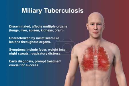 Foto de Una ilustración fotorrealista en 3D que muestra la mitad superior de un hombre con piel transparente, revelando los pulmones afectados por la tuberculosis miliar - Imagen libre de derechos