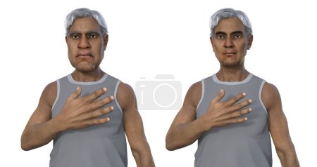 Akromegalie in einem Mann, und der gleiche gesunde Mann. 3D-Illustration, die eine Vergrößerung der Hände und des Gesichts durch eine Überproduktion von Somatotropin durch einen Tumor der Hypophyse zeigt.