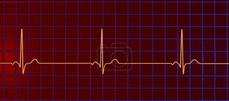 Photo for A detailed 3D illustration of an electrocardiogram displaying sinus bradycardia, a condition characterized by a slow heart rate originating from the sinus node, typically below 60 beats per minute. - Royalty Free Image