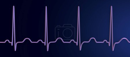 Foto de Una ilustración 3D detallada de un electrocardiograma ECG que muestra taquicardia sinusal, un ritmo cardíaco regular con frecuencia cardíaca que es superior al límite superior de la normalidad de 90-100 lpm en adultos. - Imagen libre de derechos