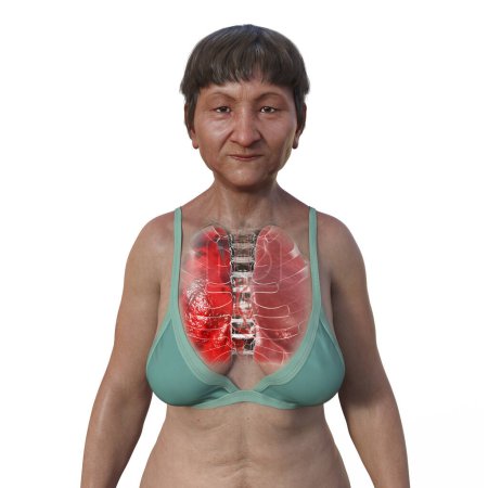 Foto de Una ilustración fotorrealista en 3D de la mitad superior de una mujer con piel transparente, mostrando los pulmones afectados por la neumonía. - Imagen libre de derechos