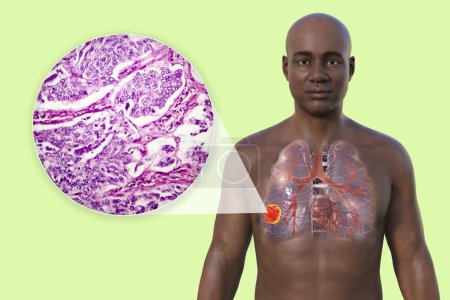 Photo for A 3D photorealistic illustration of the upper half part of an African man with transparent skin, revealing the presence of lung cancer, along with a micrograph image of lung adenocarcinoma - Royalty Free Image