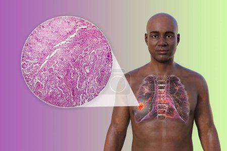 Foto de Una ilustración fotorrealista en 3D de la mitad superior de un hombre africano con piel transparente, que revela la presencia de cáncer de pulmón, junto con una imagen micrográfica del adenocarcinoma de pulmón - Imagen libre de derechos