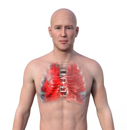 Foto de Una ilustración fotorrealista en 3D que muestra la mitad superior de un hombre con piel transparente, revelando los pulmones afectados por la neumonía. - Imagen libre de derechos