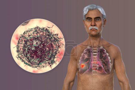 Photo for A 3D photorealistic illustration of the upper half part of a man with transparent skin, revealing the presence of lung cancer, and close-up view of cancer cells. - Royalty Free Image