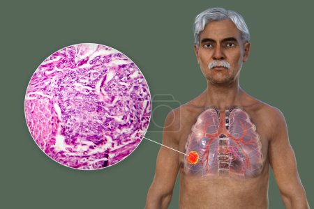 Photo for A 3D photorealistic illustration of the upper half part of a man with transparent skin, revealing the presence of lung cancer, along with a micrograph image of lung adenocarcinoma. - Royalty Free Image