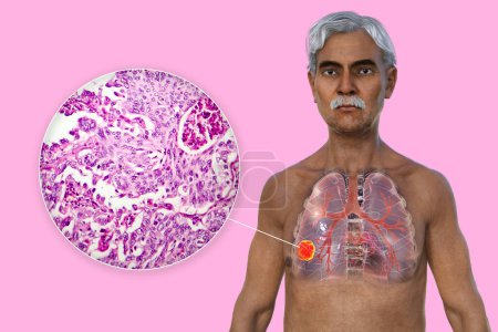 Téléchargez les photos : Illustration photoréaliste 3D de la moitié supérieure d'un homme à la peau transparente, révélant la présence d'un cancer du poumon, accompagnée d'une image micrographique de l'adénocarcinome pulmonaire. - en image libre de droit