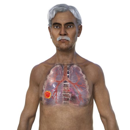 Photo for A 3D photorealistic illustration of the upper half part of a man with transparent skin, revealing the presence of lung cancer. - Royalty Free Image