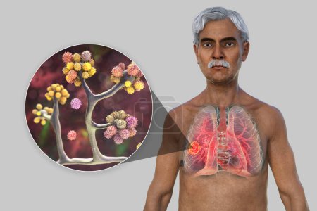Foto de Ilustración fotorrealista en 3D de la mitad superior de un paciente masculino de edad avanzada con piel transparente, revelando una lesión de mucormicosis pulmonar, con vista de cerca de los hongos Cunninghamella bertholletiae. - Imagen libre de derechos