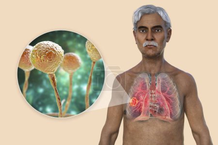 Téléchargez les photos : Illustration photoréaliste en 3D de la moitié supérieure d'un patient âgé à la peau transparente, révélant une lésion de mucormycose pulmonaire, avec vue rapprochée des champignons Mucor. - en image libre de droit