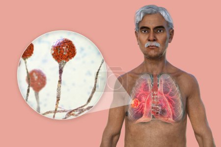 Foto de Una ilustración fotorrealista en 3D de la mitad superior de un paciente de edad avanzada con piel transparente, revelando una lesión de mucormicosis pulmonar, con vista cercana de los hongos Mucor. - Imagen libre de derechos
