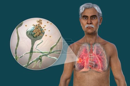 Téléchargez les photos : Illustration photoréaliste 3D de la moitié supérieure d'un patient masculin âgé à peau transparente, révélant une lésion de mucormycose pulmonaire, avec vue rapprochée des champignons Rhizopus. - en image libre de droit