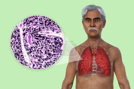 Photo for A 3D illustration of the upper half part of a man with transparent skin, revealing the condition of smoker's lungs, along with a micrograph image of lungs affected by smoking. - Royalty Free Image