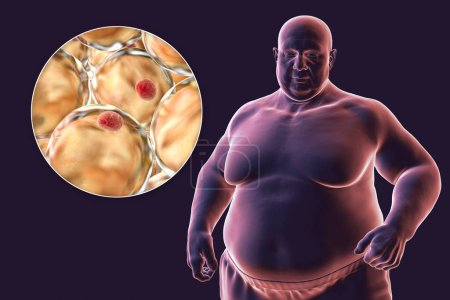 Una ilustración médica en 3D que representa a un hombre con sobrepeso con una visión cercana de los adipocitos, destacando el papel de estas células grasas en la obesidad.