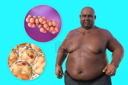 Téléchargez les photos : Illustration médicale 3D montrant un homme en surpoids avec une vue rapprochée des adipocytes et des molécules de cholestérol, mettant en évidence la relation entre l'obésité et le métabolisme du cholestérol. - en image libre de droit