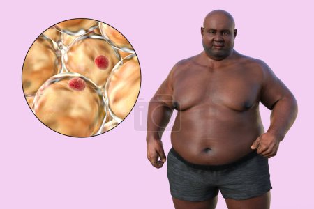 Foto de Una ilustración médica en 3D que representa a un hombre con sobrepeso con una visión cercana de los adipocitos, destacando el papel de estas células grasas en la obesidad. - Imagen libre de derechos