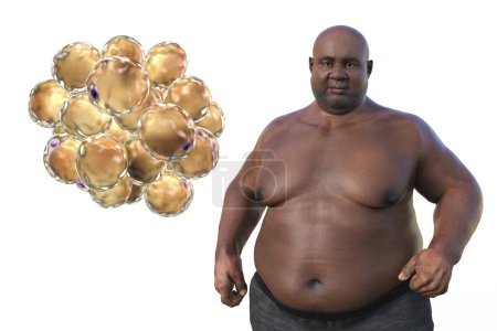 Téléchargez les photos : Illustration médicale 3D représentant un homme en surpoids avec une vue rapprochée des adipocytes, soulignant le rôle de ces cellules graisseuses dans l'obésité. - en image libre de droit