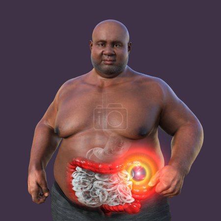 Photo for An overweight man with transparent skin, showcasing the digestive system, and highlighting the presence of large intestine spasms associated with irritable bowel syndrome, 3D illustration. - Royalty Free Image