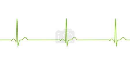 Una ilustración 3D detallada de un electrocardiograma que muestra bradicardia sinusal, una condición caracterizada por una frecuencia cardíaca lenta que se origina en el nodo sinusal, típicamente por debajo de 60 latidos por minuto..