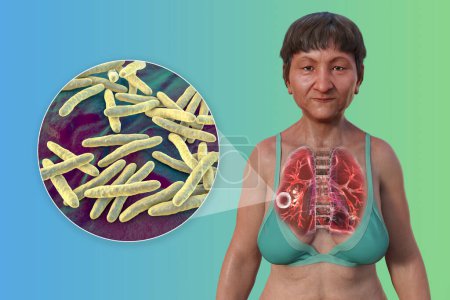 Téléchargez les photos : Illustration 3D de la moitié supérieure d'une patiente à peau transparente montrant les poumons atteints de tuberculose caverneuse et vue rapprochée de la bactérie Mycobacterium tuberculosis. - en image libre de droit