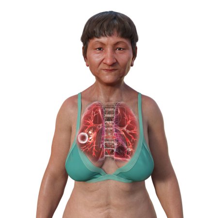Téléchargez les photos : Illustration photoréaliste en 3D de la moitié supérieure d'une patiente à la peau transparente, montrant les poumons atteints de tuberculose caverneuse. - en image libre de droit