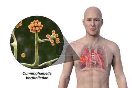 Photo for A 3D photorealistic illustration of the upper half part of a man with transparent skin, revealing a lung mucormycosis lesion, with close-up view of Cunninghamella bertholletiae fungi. - Royalty Free Image