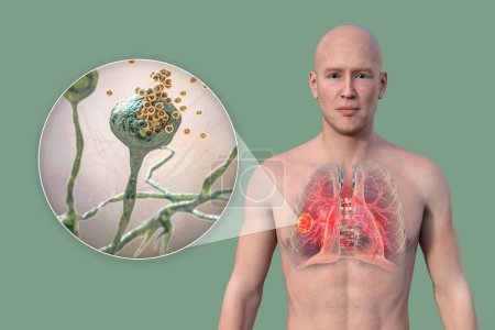 Photo for A 3D photorealistic illustration of the upper half part of a man with transparent skin, revealing a lung mucormycosis lesion, with close-up view of Rhizopus fungi. - Royalty Free Image