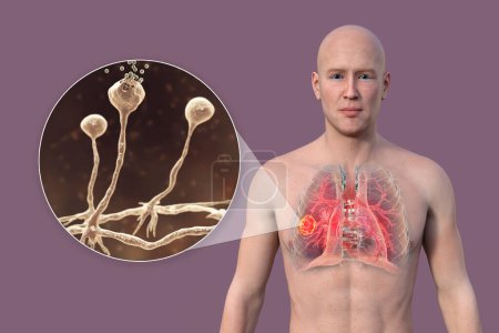 Téléchargez les photos : Illustration photoréaliste 3D de la moitié supérieure d'un homme à peau transparente, révélant une lésion de mucormycose pulmonaire, avec vue rapprochée des champignons Rhizopus. - en image libre de droit
