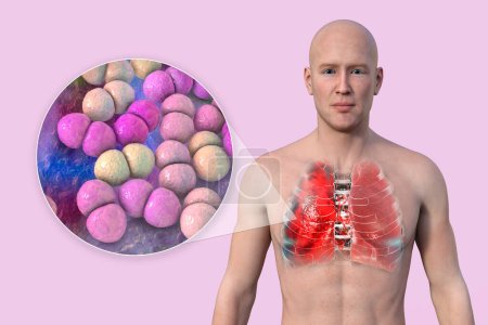 Foto de Una ilustración fotorrealista 3D que muestra la mitad superior de un hombre con la piel transparente, revelando los pulmones afectados por la neumonía, y la vista de cerca de la bacteria Streptococcus pneumoniae. - Imagen libre de derechos