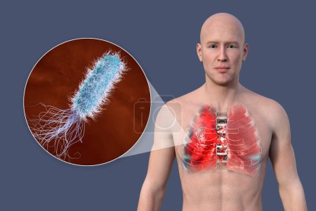 Foto de Una ilustración fotorrealista en 3D que muestra la mitad superior de un hombre con la piel transparente, revelando los pulmones afectados por la neumonía, y vista de cerca de la bacteria Pseudomonas aeruginosa. - Imagen libre de derechos