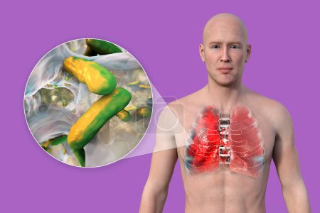 Foto de Una ilustración fotorrealista en 3D que muestra la mitad superior de un hombre con la piel transparente, revelando los pulmones afectados por la neumonía, y vista de cerca de la bacteria Pseudomonas aeruginosa. - Imagen libre de derechos