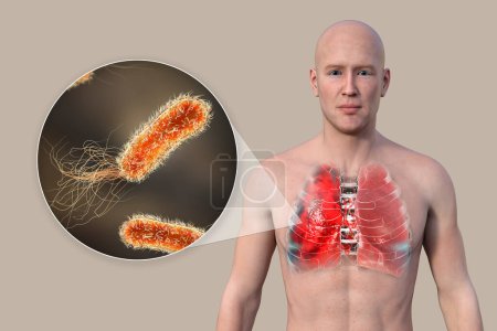 Photo for A 3D photorealistic illustration showcasing the upper half part of a man with transparent skin, revealing the lungs affected by pneumonia, and close-up view of Pseudomonas aeruginosa bacteria. - Royalty Free Image