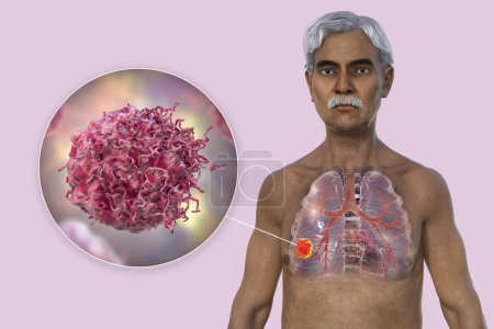 Foto de Una ilustración fotorrealista en 3D de la mitad superior de un hombre con piel transparente, que revela la presencia de cáncer de pulmón y la visión cercana de las células cancerosas. - Imagen libre de derechos