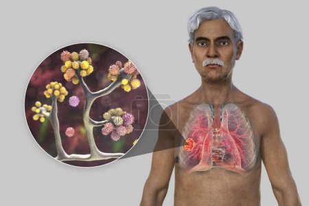 Foto de Ilustración fotorrealista en 3D de la mitad superior de un paciente masculino de edad avanzada con piel transparente, revelando una lesión de mucormicosis pulmonar, con vista de cerca de los hongos Cunninghamella bertholletiae. - Imagen libre de derechos
