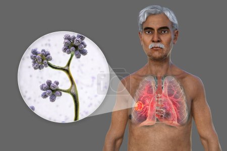 Photo for A 3D photorealistic illustration of the upper half part of a senior male patient with transparent skin, revealing a lung mucormycosis lesion, with close-up view of Cunninghamella bertholletiae fungi. - Royalty Free Image
