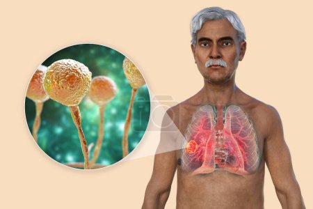 Foto de Una ilustración fotorrealista en 3D de la mitad superior de un paciente de edad avanzada con piel transparente, revelando una lesión de mucormicosis pulmonar, con vista cercana de los hongos Mucor. - Imagen libre de derechos