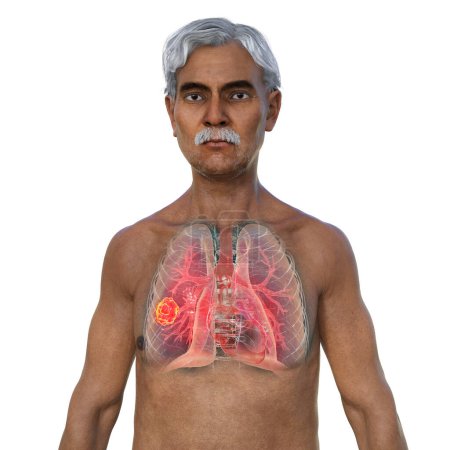Foto de Una ilustración fotorrealista 3D de la mitad superior de un hombre con piel transparente, revelando una lesión de mucormicosis pulmonar. - Imagen libre de derechos