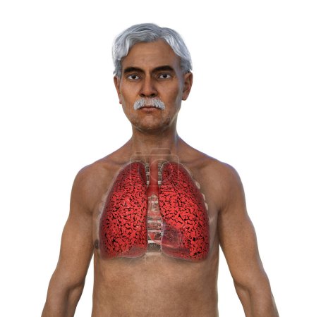 Téléchargez les photos : Illustration photoréaliste 3D de la moitié supérieure d'un homme à la peau transparente, révélant l'état des poumons du fumeur. - en image libre de droit