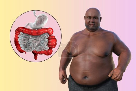 Foto de Un hombre con sobrepeso, y vista de cerca de su sistema digestivo destacando la presencia de espasmos del intestino grueso asociados con el síndrome del intestino irritable, ilustración 3D. - Imagen libre de derechos