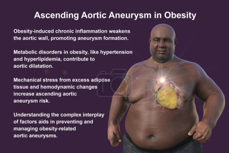 Photo pour Illustration scientifique 3D représentant un homme obèse à la peau transparente, révélant un anévrisme aortique ascendant, un concept soulignant l'association de l'anévrisme aortique ascendant avec l'obésité. - image libre de droit