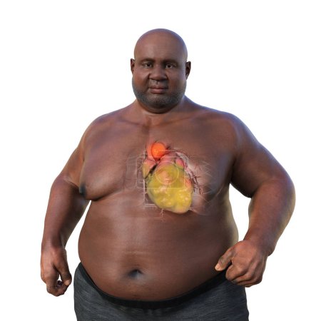 Photo pour Illustration scientifique 3D représentant un homme obèse à la peau transparente, révélant un anévrisme aortique ascendant, un concept soulignant l'association de l'anévrisme aortique ascendant avec l'obésité. - image libre de droit