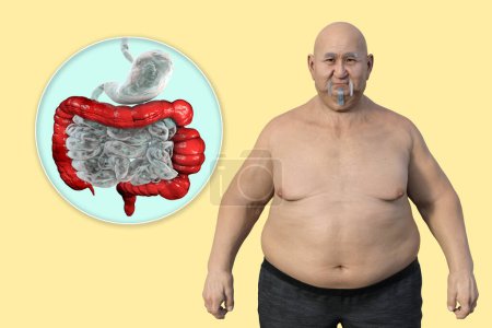 Photo for An overweight man, and close-up view of his digestive system highlighting the presence of large intestine spasms associated with irritable bowel syndrome, 3D illustration. - Royalty Free Image
