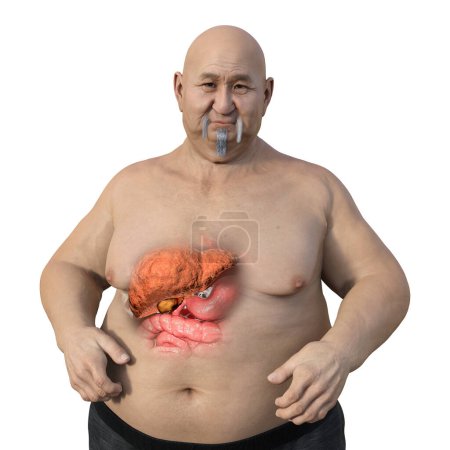 Téléchargez les photos : Illustration médicale 3D représentant un homme en surpoids à la peau transparente, mettant en valeur le foie et soulignant la présence de stéatose hépatique. - en image libre de droit