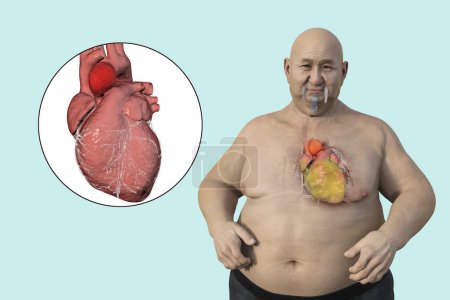 Téléchargez les photos : Illustration scientifique 3D représentant un homme obèse à la peau transparente, révélant un anévrisme aortique ascendant, un concept soulignant l'association de l'anévrisme aortique ascendant avec l'obésité. - en image libre de droit