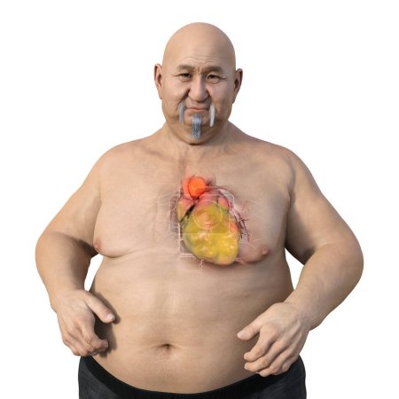 Téléchargez les photos : Illustration scientifique 3D représentant un homme obèse à la peau transparente, révélant un anévrisme aortique ascendant, un concept soulignant l'association de l'anévrisme aortique ascendant avec l'obésité. - en image libre de droit