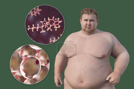 Eine medizinische 3D-Illustration mit einem übergewichtigen Mann mit einer Nahsicht auf Fettzellen und Cholesterinmoleküle, die die Beziehung zwischen Fettleibigkeit und Cholesterinstoffwechsel verdeutlicht.