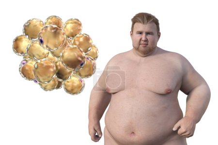 Téléchargez les photos : Illustration médicale 3D représentant un homme en surpoids avec une vue rapprochée des adipocytes, soulignant le rôle de ces cellules graisseuses dans l'obésité. - en image libre de droit