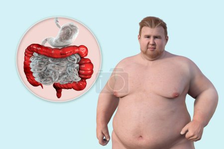 Téléchargez les photos : Un homme en surpoids, et une vue rapprochée de son système digestif mettant en évidence la présence de spasmes du gros intestin associés au syndrome du côlon irritable, illustration 3D. - en image libre de droit