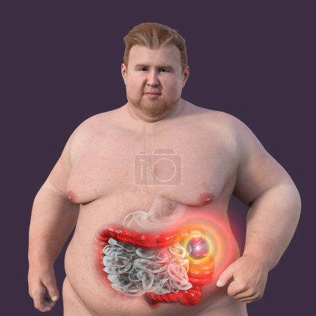An overweight man with transparent skin, showcasing the digestive system, and highlighting the presence of large intestine spasms associated with irritable bowel syndrome, 3D illustration.